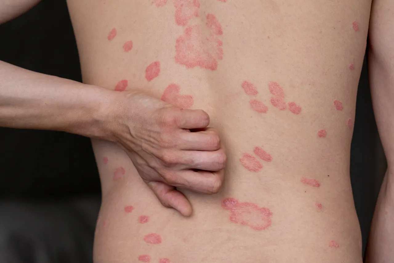 Hauterkrankungen behandeln in Rostock: Psoriasis-Herde am Rücken eines Patienten