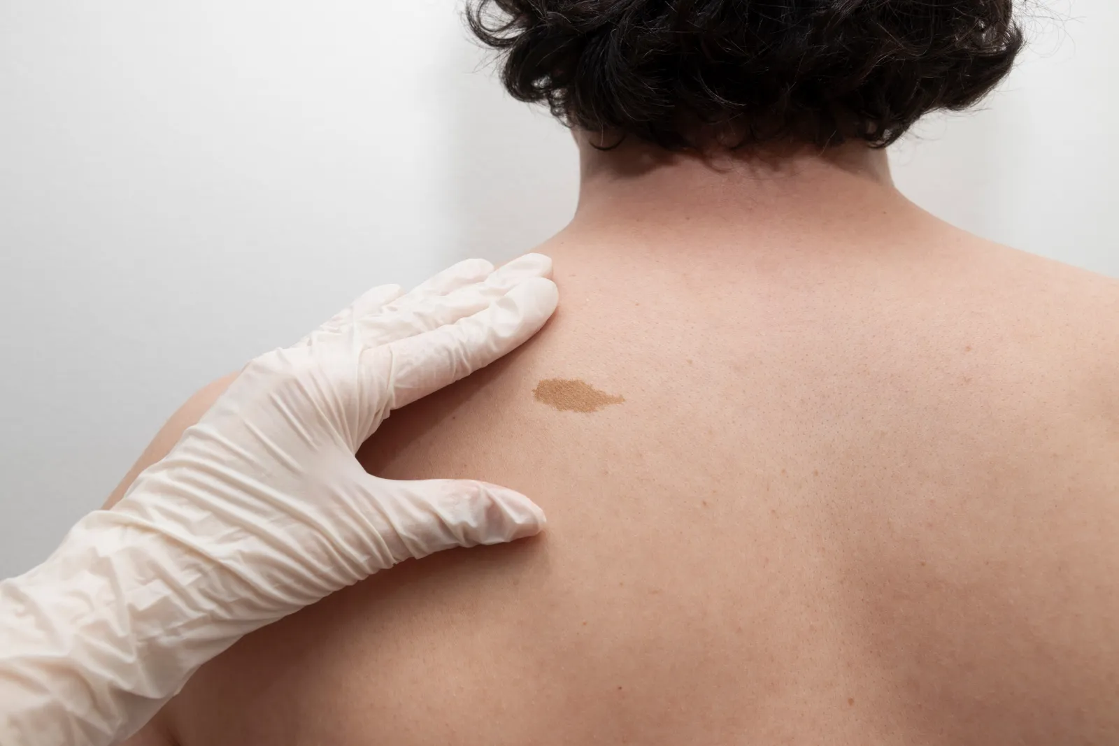 Muttermal entfernen in Rostock: dermatologische Untersuchung eines Muttermals am Rücken beim Facharzt Dr. Dr. Ole Jung